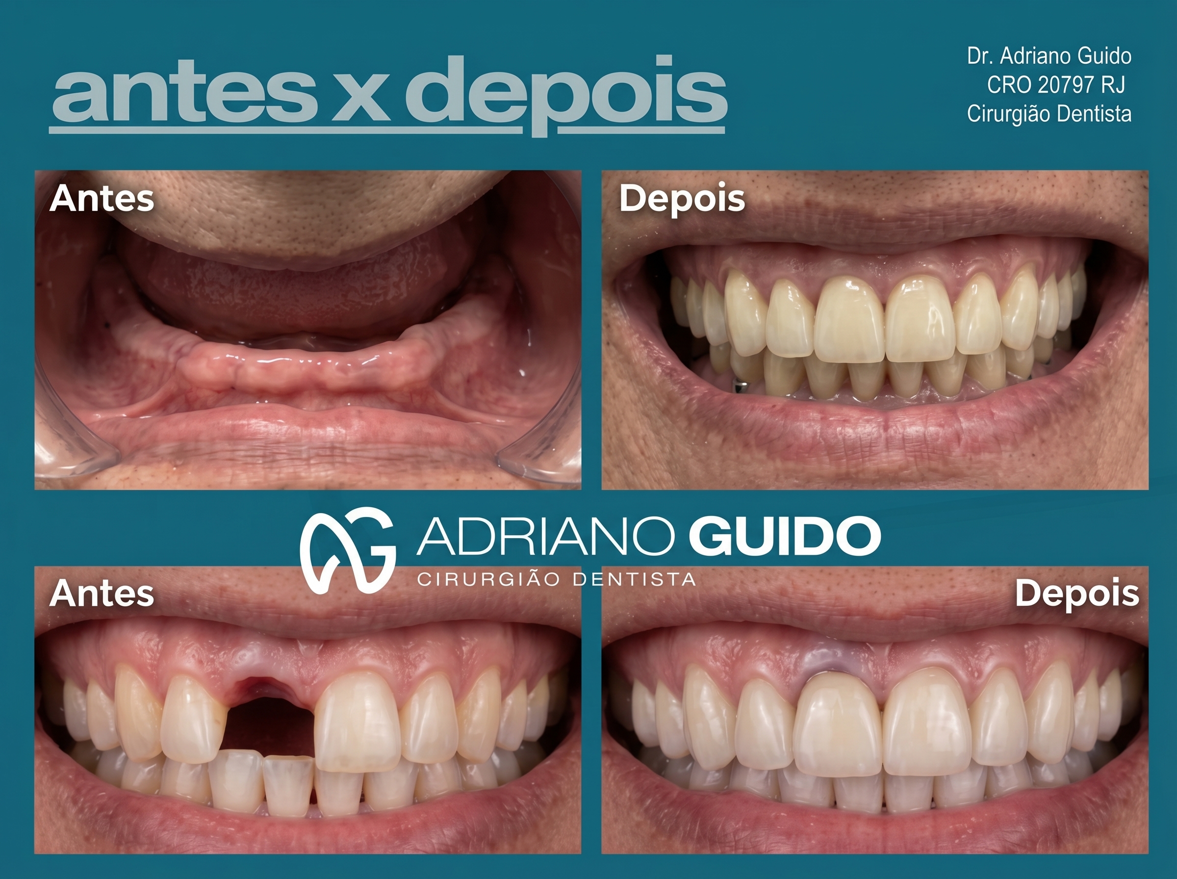 Antes e depois — resultado de implante dentário pelo Dr. Adriano Guido
